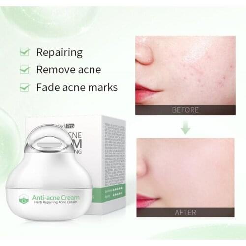 8g Effective anti-acne cream treatment Fade acne spots oil control shrink pores whitening moisturizing acne Face cream skin care