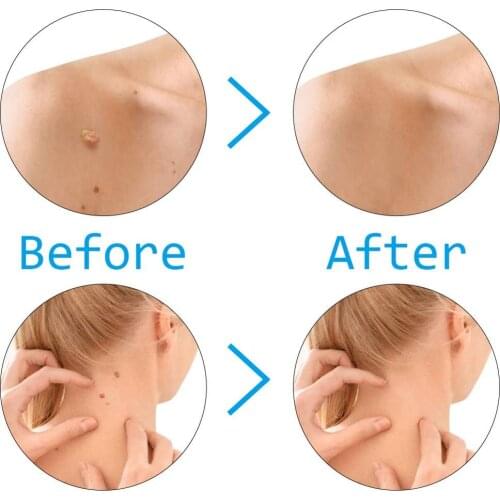 Skin tag remover remove Medical Skin Tag Kill mole wart treatment face Skin Tag Removal Tool Acne Remover Cleansing Micro Band