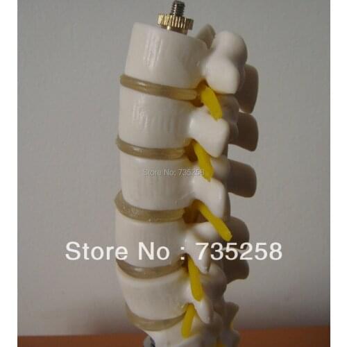 Mini Lumbar Vertebrae with Sacrum & Coccyx and Herniated Disc model