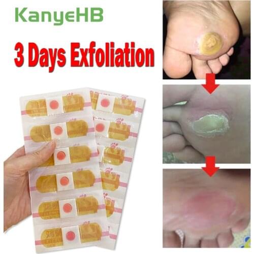 12Pcs Foot Care Sticker Medical Patch Foot Corn Removal Pads Warts Thorn Curative Patches Calluses Remove Callosity Detox A291