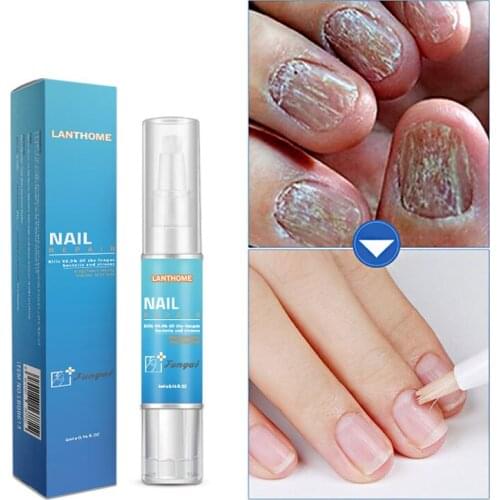 Pro Nail Fungal Treatment Liquid Remedy Nail Fungus Treatment Feet Care Whitening Toe From Nail Fungus Remove Gel TSLM1