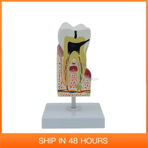 Enlarged Human Teeth Care Model Tooth Decay Dental Caries Medical Student Supplies Teaching Resources Anatomical
