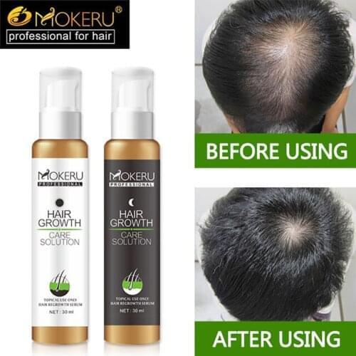 Mokeru 30 Days Hair ReGrowth Lotion Natural Castor Oil for Hair Growth Hair Loss Products for Men Hair Treatment Baldness