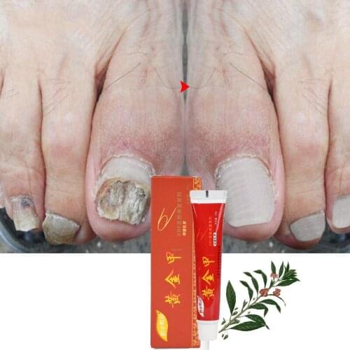 Best Fungus Nail Treatment Cream Onychomycosis Paronychia Anti Fungal Nail Infection Fights Bacteria And Fungus Naturally