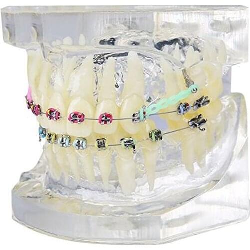 1 PCS Transparent Tooth Model Teeth Malocclusion Orthodontic Colorful Model Dental Study Dentist Teaching