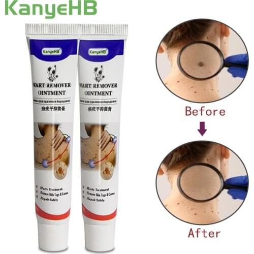 2pcs Remover Warts Cream Skin Tag Remover Cream Wart Treatment Ointment Herbal Extract Foot Corn Cream Acne Warts Ointment A634