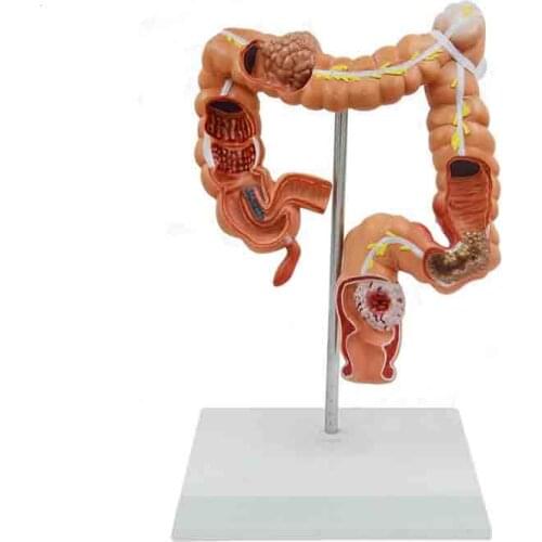 Human colon disease model anorectal Department of Gastroenterology large intestine model
