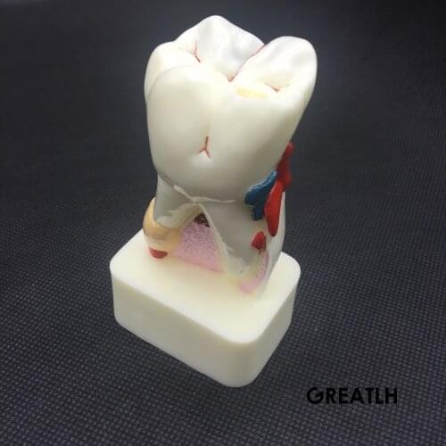 Best Dentist Dental Study Teach Tooth Model Teeth Disease Model new