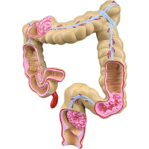 Colorectal pathological anatomical model Intestinal disease colon lesion anatomical model