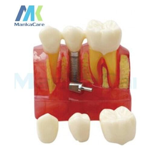 Dental Demonstration Teeth Model Implant Analysis Crown Bridge 4 Times Dental Implant Analysis Crown Bridge Demonstration