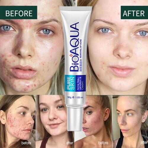 Hot 30g Removal Acne Cream Treatment Blackhead Moisturizing Oil Control Shrink Pores Nourish facial Care whitening Cosmetics
