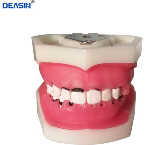Dental Periodontal Disease Model / Medical and teaching teeth Model