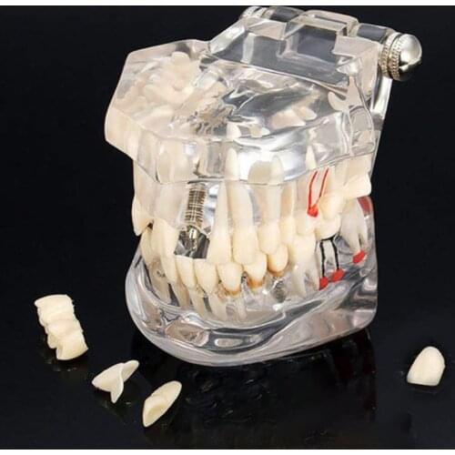 Dental Model Teeth Implant Restoration Bridge Teaching Study Tooth Medical Science Disease Dentist Dentistry Products