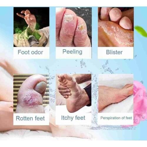 30ml 20g Anti Fungal Infections Foot Cream Treatment Foot Athlete Beriberi Peeling Erosion Relief Itch Blisters Ointment Pa L3H6