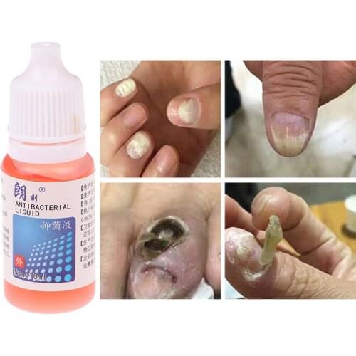 10ml Anti Fungal Nail Infection Chinese Herbal Care Oil Nail Fungus Repair Treatment Pen Products Onychomycosis Paronychia