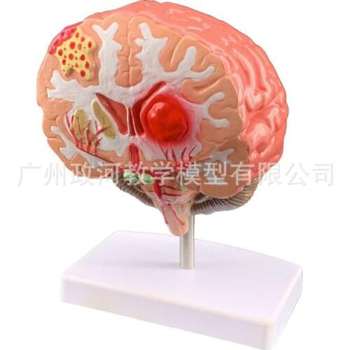 Human brain disease model Brain anatomy Neurosurgery Brain pathology Cerebral lesion model