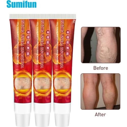 3pcs Varicose Veins Cream Ointment For Varicose Veins Of Legs Varicosity Angiitis Remedy Treatment Phlebitis Pain Relief D3175