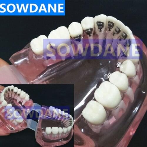 Dental Orthodontic Model With Lingual Bracket for Dentist-Patient Communication Study Transparent Tooth Model