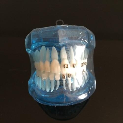 Teeth Model Blue Dental Orthodontics Communication Model With 4 Types of Brackets