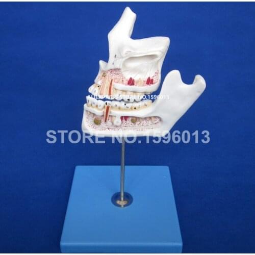 Pathologic Tooth with Jaw model,Teeth Disease model,Dental Caries,Decayed Teeth and Pulpitis Model