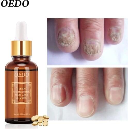 Herbal Fungal Nail Treatment Essential oil Hand and Foot Whitening Toe Nail Fungus Removal Infection Feet Care Polish Nail Gel