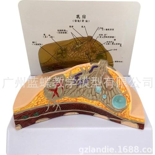 Medical Disease Cancer Breast Anatomy Model Human Body Model Anatomical Pathological Breast Model