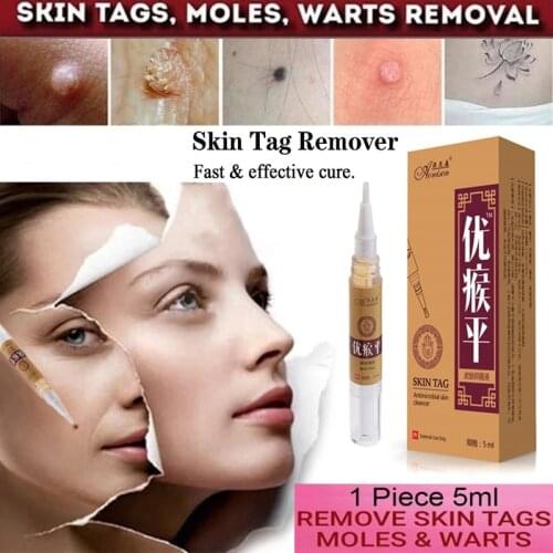 Skin Tag Remover Medical Papillomas Removal of Warts Liquid From Skin Tags Removing Against Moles Remover Anti Verruca Remedy