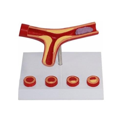 Human Vascular Model arterial atherosclerosis model Cardiovascular Arteriosclerosis Model Thrombosis model