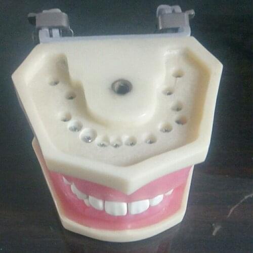 Dental Periodontal Disease Model Periodontal pathological model