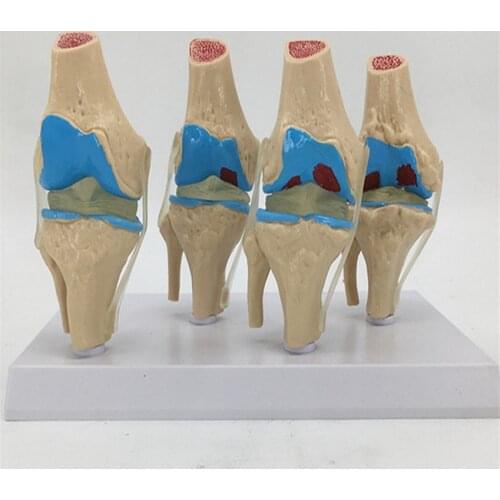 1pcs Anatomical Human Knee Joint Model Human Stage 4 Knee Joint Model for School Teaching Display Models Disease Process