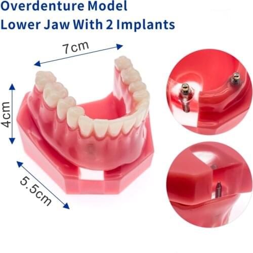 Dental Inferior Implant Overdenture 6007 Teeth Model 2 Implants Tooth Model