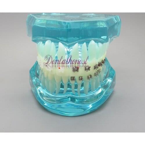 BLUE Dental Orthodontics Communication Model With 4 Types of Brackets