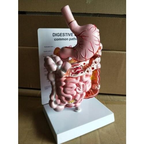 Human gastrointestinal pathology model doctor-patient communication demonstration model digestive system disease teaching model