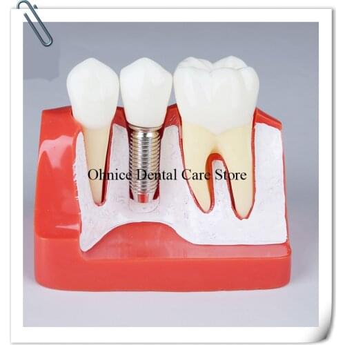 Dental Implant teaching model Comminication teeth model/Dental Implant Analysis teeth model M2017 Dentistry Clinic