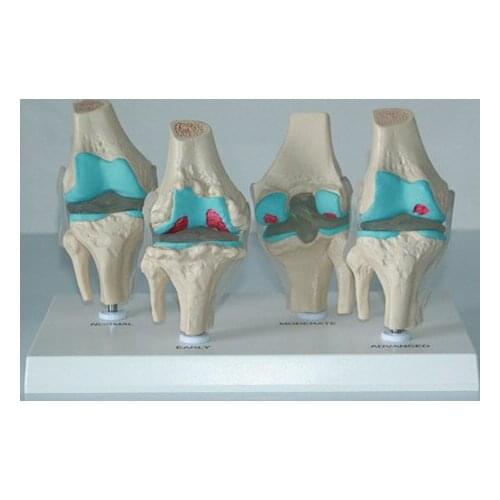 Knee Lesions arthritis model human skeleton model knee osteoarthritis disease model knee joint model