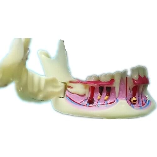 Treatment Model Anatomy of Gums Dental Study Teach Teeth Model Dental Mandible Model Endodontic