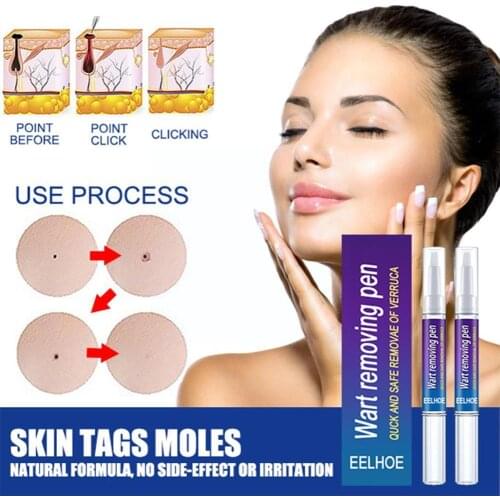 3/6ml Liquid Genital Wart Treatment Papillomas Removal Of Warts Skin Tags Removing Against Moles Remover Anti Verruca Remedy