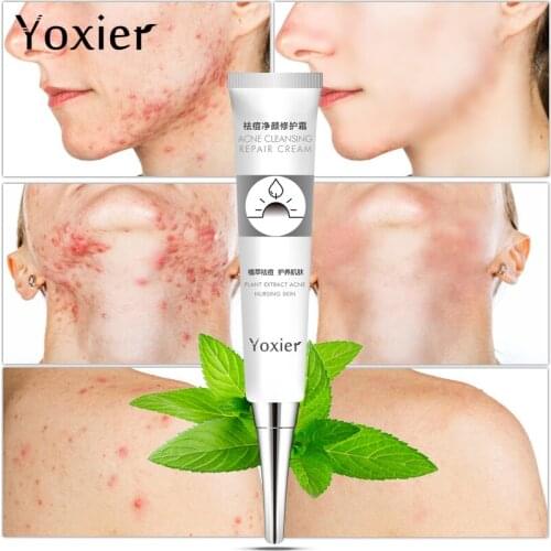 Yoxier Treatment Acne Face Cream Remove Scars Acne Blackhead Facial Cream Oil Control Shrink Pores Whitening Skin Care