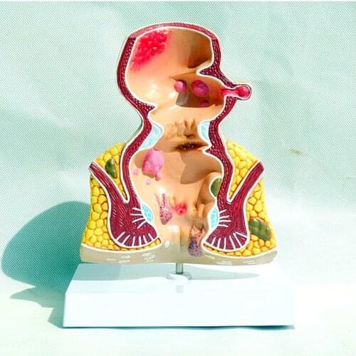 Colorectal hemorrhoids Pathological model internal and external anatomy of hemorrhoids