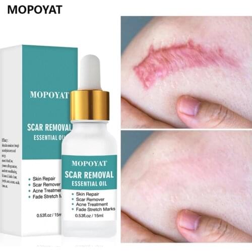 Acne Scar Essential Oil Remove New Old Scar Stretch Marks Acne Spots Treatment Skin Repair Smoothing Whitening Face Serum 15ml