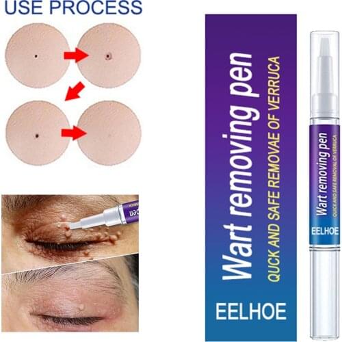 Wart Remover Skin Tag Cream Papillomas Moles Removal Painless Spot Face Wart Freckle Cream Oil Plaster Herbal Medicine Ointment