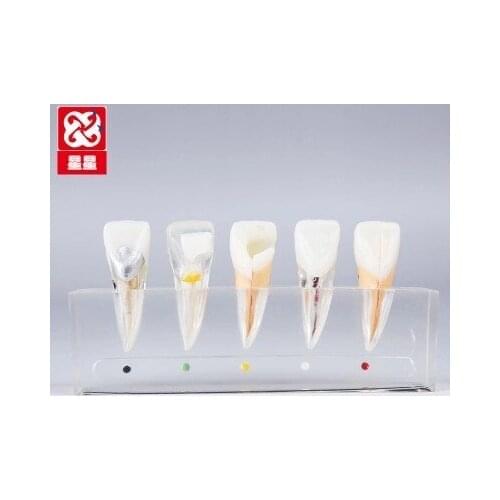 Endodontic treatment Upper central incisor pathology Patient communication model free shipping