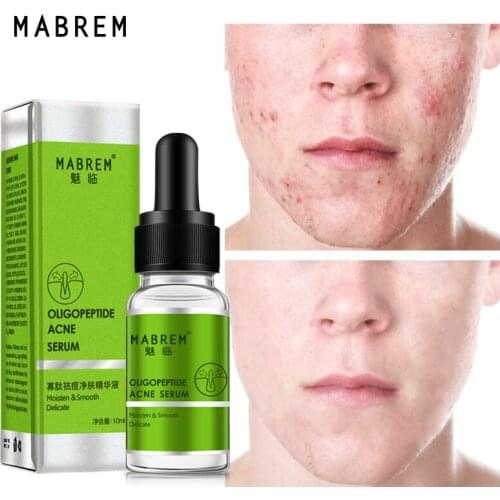 MABREM Oligopeptide Acne Treatment Serum Deep Cleaning Shrink pores Repair Remove Acne Lotion Whitening Brighten Essence Care