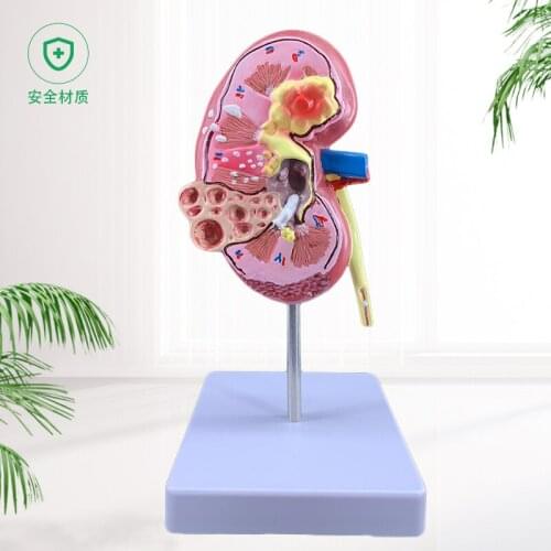 Human kidney anatomical model lesion kidney teaching demonstration model education use