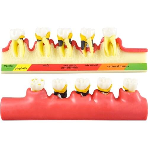 Typodont Teach Models Dentistry Equipment Periodontal Disease Teeth Model M4010 For Demonstration Dentist Communication Model