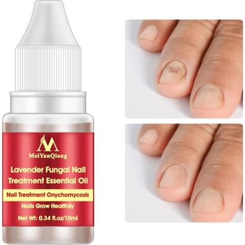 10ml Fungal Nail Treatment Serum Onychomycosis Paronychia Anti-Fungal Nail Infection Herbal Toe Fungus Foot Repair Essence Care
