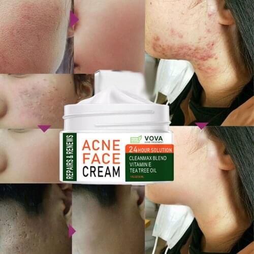 VOVA Effective Acne Removal Cream Acne Treatment Fade Acne Spots Oil Control Shrink Pores Whitening Moisturizing Acne Cream Skin