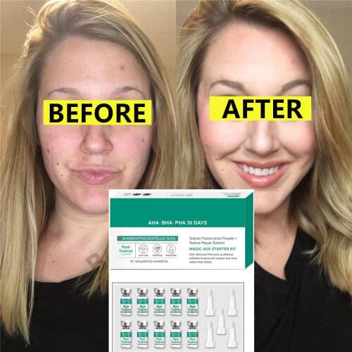 AHA BHA PHA 30 Days Tea Tree + Centella 14.5% Lyophilized Powder Kit Deep Cleaning Exfoliating Moisturizing Brighten Skin Tone