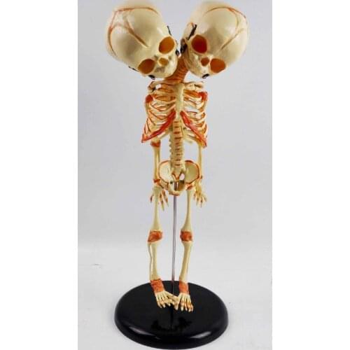 Babys Two-headed Skull Human Newborn Baby Double Head Anatomy Skull Skeleton Anatomical Brain Education Anatomical Study Model