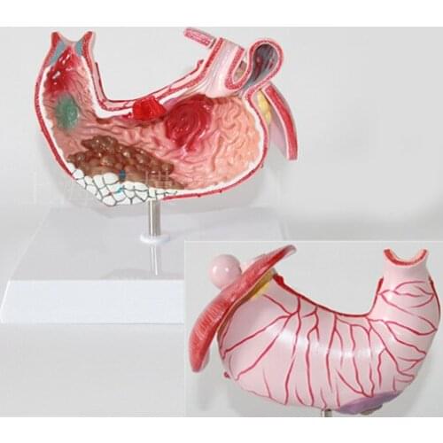 Stomach Anatomical model Gastric Distal Model Stomach Gastric Common Diseases